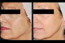Skin Rejuvenation Treatments 8 Skin Rejuvenation before and after