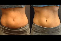 before and after Sculpsure Body Contouring in Abu Dhabi