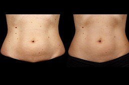 before and after Sculpsure Body Contouring