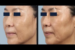 Skin Rejuvenation Treatments 6 before and after Skin Rejuvenation treatment