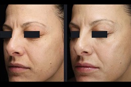 Skin Rejuvenation Treatments 7 before and after Skin Rejuvenation