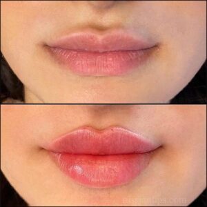 How long do Russian lip fillers last
