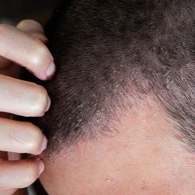 Scalp Eczema Symptoms & Treatments 2 Scalp Eczema