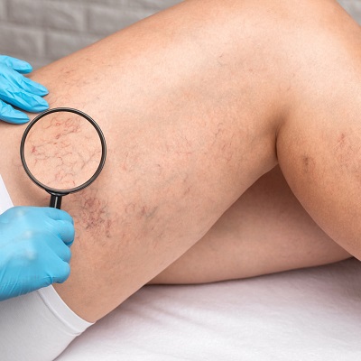 Spider Veins Cost in Abu Dhabi