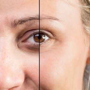 Blog 17 Eye Bag Removal Cost in Abu Dhabi