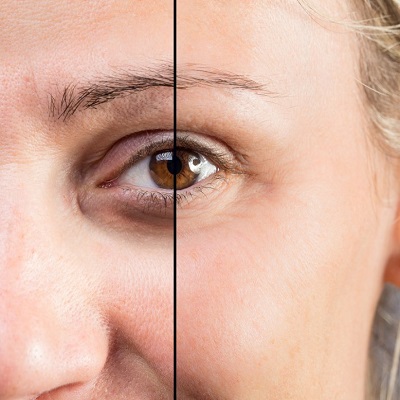 Eye Bag Removal Cost in Abu Dhabi