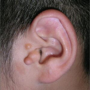 Blog 11 Preauricular Tag Removal Cost in Abu Dhabi