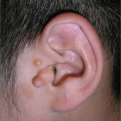 Preauricular Tag Removal Cost in Abu Dhabi