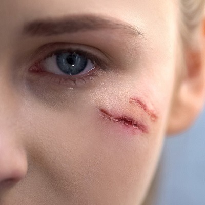 Surgical Scar Revision Cost in Abu Dhabi