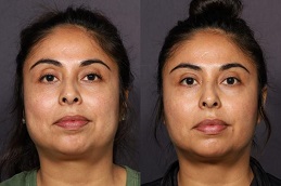 Buccal Fat Removal 7 before and after buccal fat removal