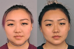 Buccal Fat Removal 6 buccal fat removal before and after