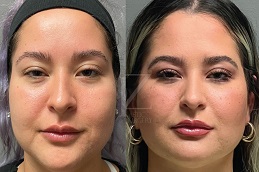 Buccal Fat Removal 8 buccal fat removal in abu dhabi before and after