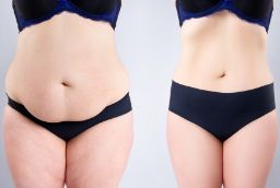 Before and After Tummy Tuck in Al Ain