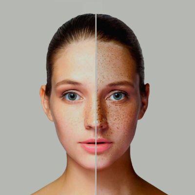 Freckles & Blemishes cost in Abu Dhabi
