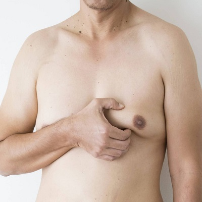 Gynecomastia in Al Ain