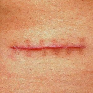 Blog 13 Post Surgical Scars Treatment cost in Abu Dhabi