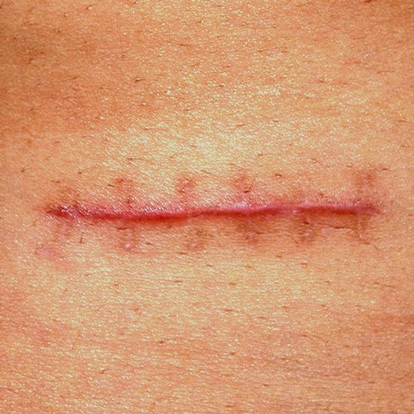 Post Surgical Scars Treatment cost in Abu Dhabi