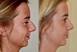 Rhinoplasty Rhinoplasty in Al Ain