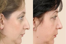 Rhinoplasty in Al Ain 5 Rhinoplasty in Al Ain Before And After