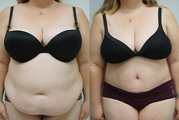 Tummy Tuck Before and After