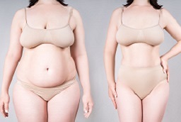 Tummy Tuck in Al Ain Before and After