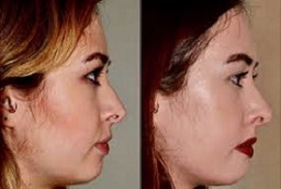 before and after Rhinoplasty in Al Ain