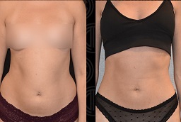 Liposuction in Al Ain 8 liposuction in Al Ain Before And After
