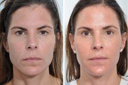 Before After Brow Lift Surgery in Abu Dhabi