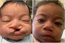 Cleft Lip Surgery (Craniofacial) 5 Before After Cleft Lip and Palate Surgery in Abu Dhabi