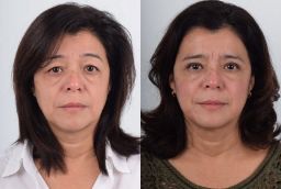 Before After Eye Bag removal in Abu Dhabi
