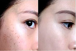 Seborrheic Keratosis Treatment 8 Before After Seborrheic Keratosis Treatment In Abu Dhabi