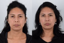 Eye Bag Removal 8 Before And After Eye Bag removal in Abu Dhabi