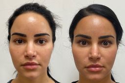 Before And After Thread Lift Treatment in Abu Dhabi