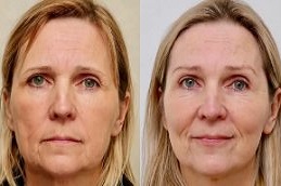 Before and After Brow Lift Surgery in Abu Dhabi