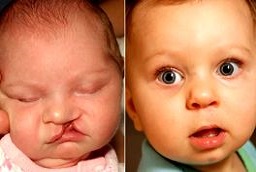 Before and After Cleft Lip and Palate Surgery in Abu Dhabi