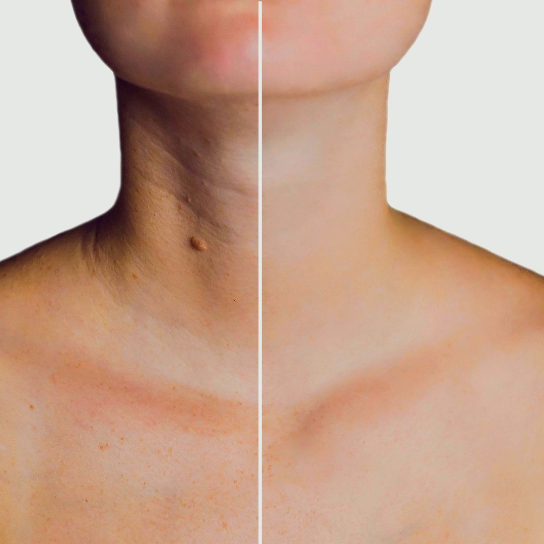 Botox For Neck Cost In Abu Dhabi