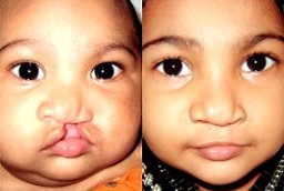 Cleft Lip and Palate Surgery in Abu Dhabi Before and After
