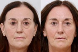 Eye Bag removal in Abu Dhabi Before and After
