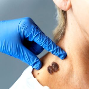 Blog 1 Seborrheic Keratosis Treatment cost in Abu Dhabi