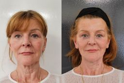 Thread Lift Treatment in Abu Dhabi Before After