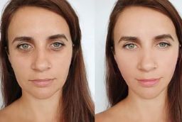 Thread Lift Treatment 8 Thread Lift Treatment in Abu Dhabi Before And After