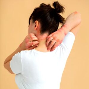 Actinic Keratosis Cost in Abu Dhabi