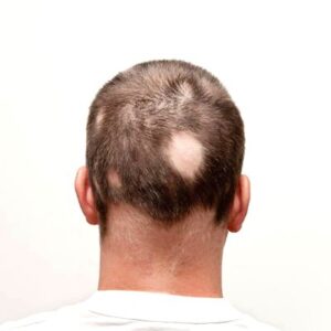 Blog 9 Alopecia Areata Treatment Cost in Abu Dhabi