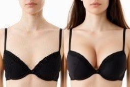 Before and After Breast Augmentation Surgery in Abu Dhabi