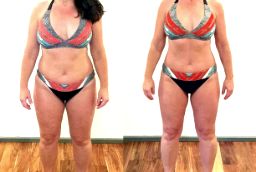 Before and After Lipotropic Injections in Abu Dhabi