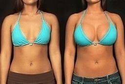Breast Augmentation Surgery 8 Breast Augmentation Surgery in Abu Dhabi Before and After