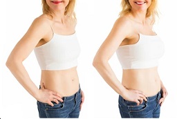 Breast Lift Surgery in Abu Dhabi Before After