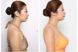 Breast Lift Surgery in Abu Dhabi Before and After