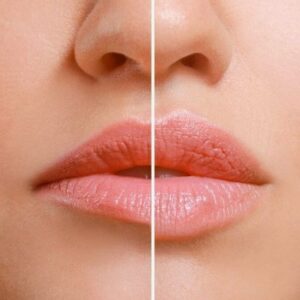 Blog 1 Fotona 4D Lip Augmentation cost in Abu Dhabi