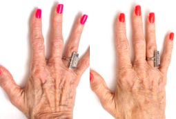Hand Rejuvenation 8 Hand Rejuvenation in Abu Dhabi Before and After